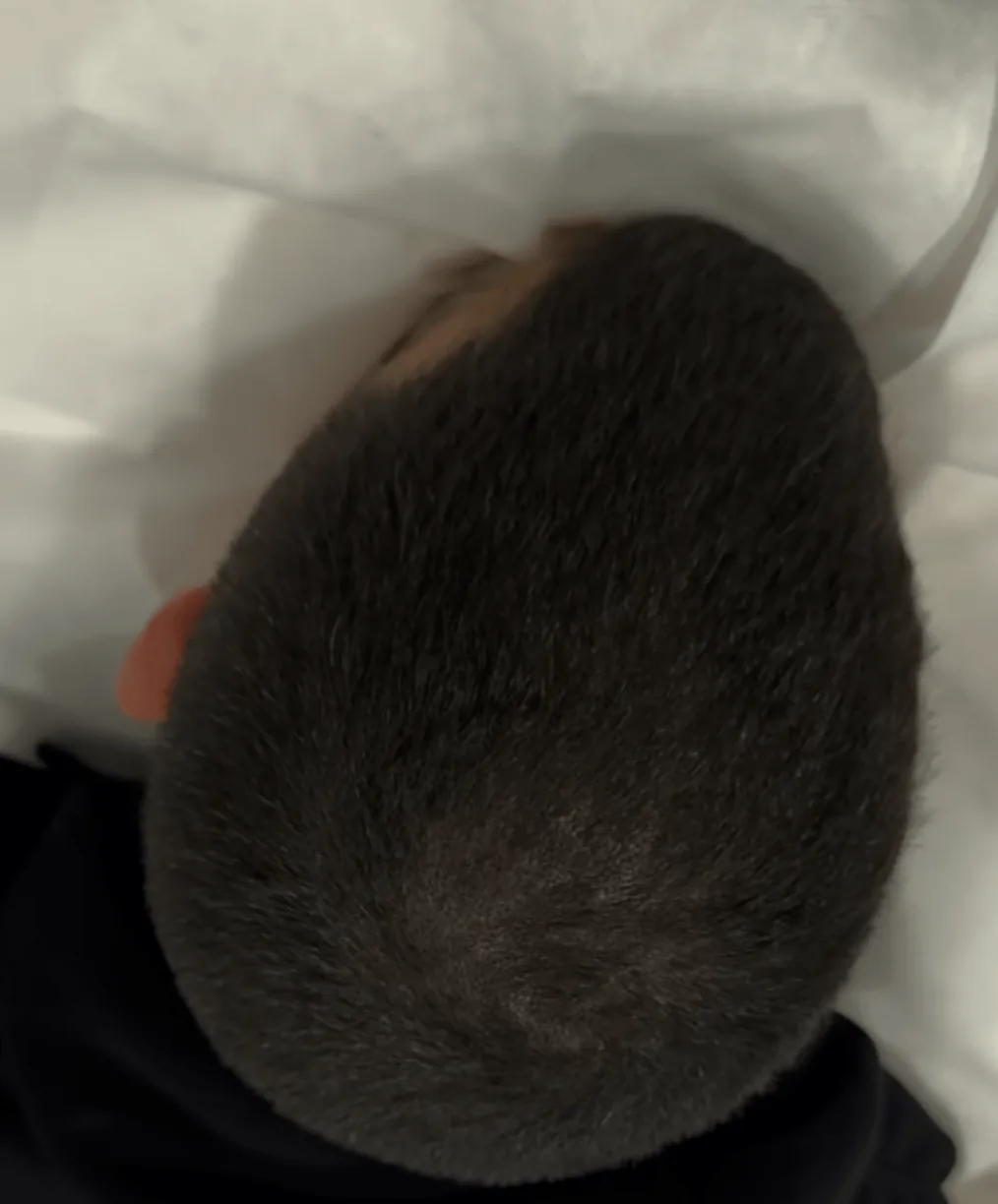 Resultado después de micropigmentación capilar caso 2